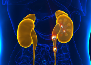 Kidney stones may be caused by lack of magnesium and too much dietary oxalate