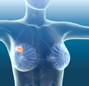 Brystkræft: Blodets selenindhold forudsiger 10-års overlevelse
