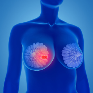 Bröstcancer: Mer selen i blodet förbättrar överlevnaden