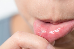 Blister i munden kan hænge sammen med D-vitaminmangel